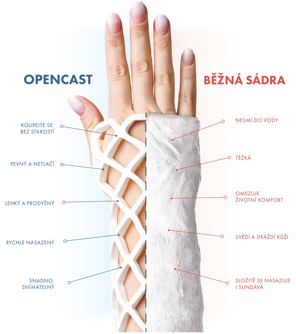 Běžná sádra vs OPEN CAST