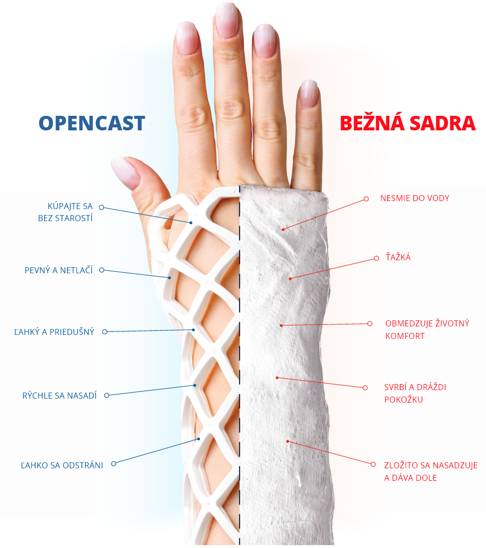 Běžná sádra vs OPEN CAST